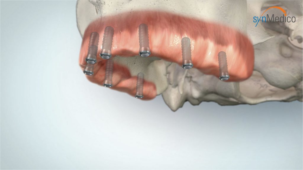 zahnlosen Kiefer mit neuen Implantaten